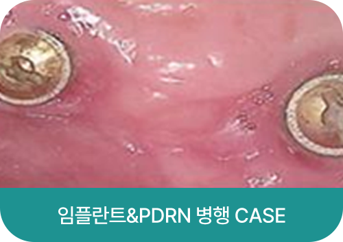 임플란트&PDRN 병행 CASE