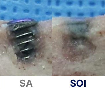 SOI 표면